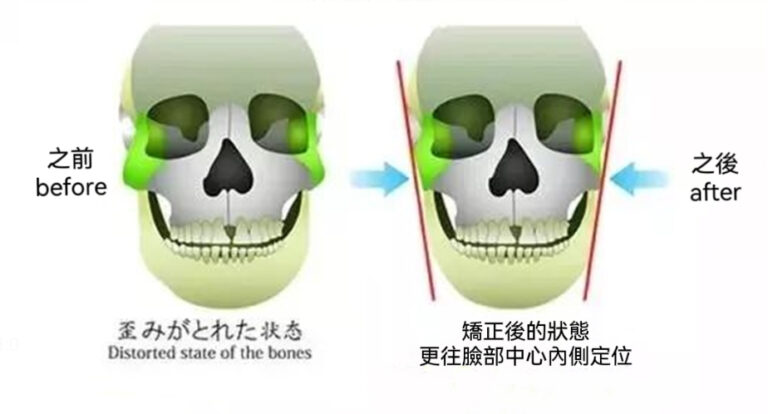 日式整骨日本日式小顏定位正骨整骨啪骨術收費價錢好介紹